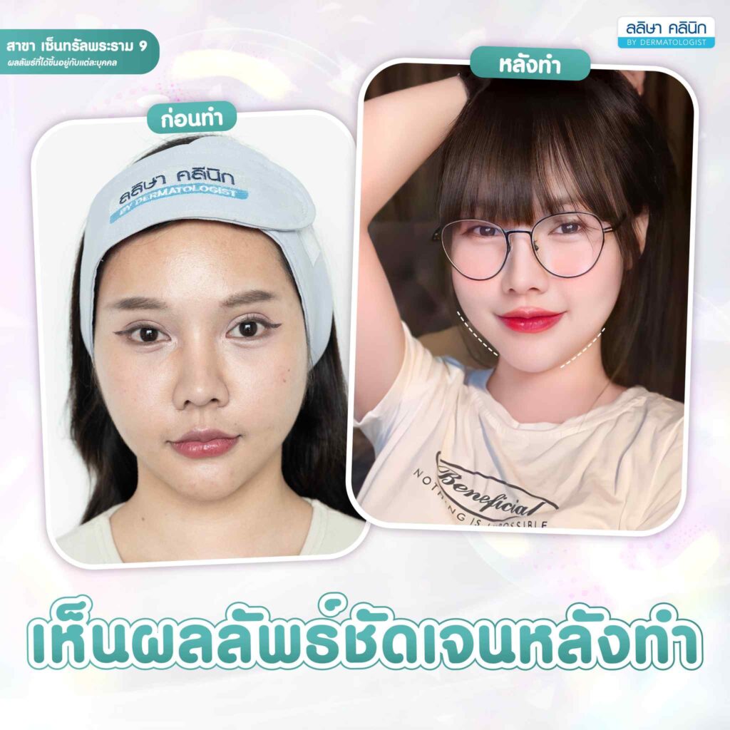 รีวิวMorpheus8