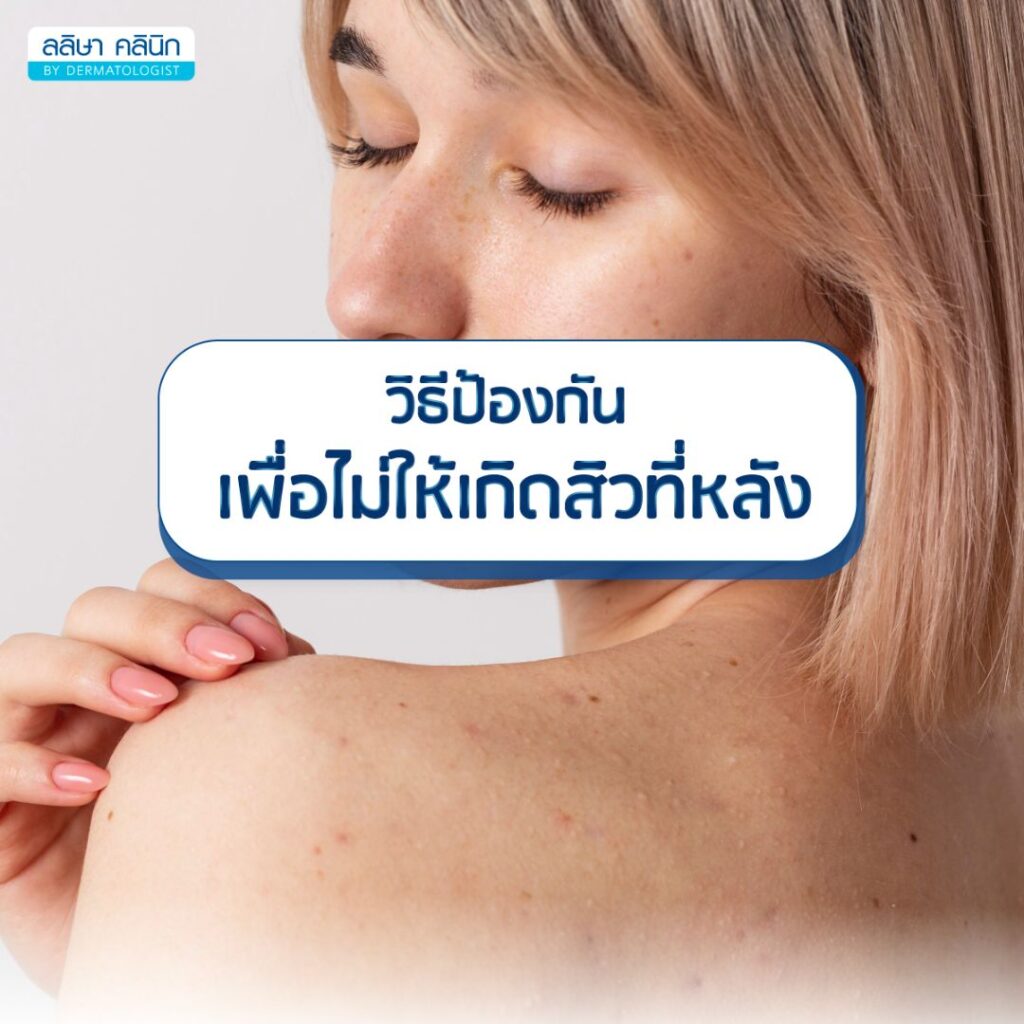 วิธีป้องกันสิวเกิดที่หลัง