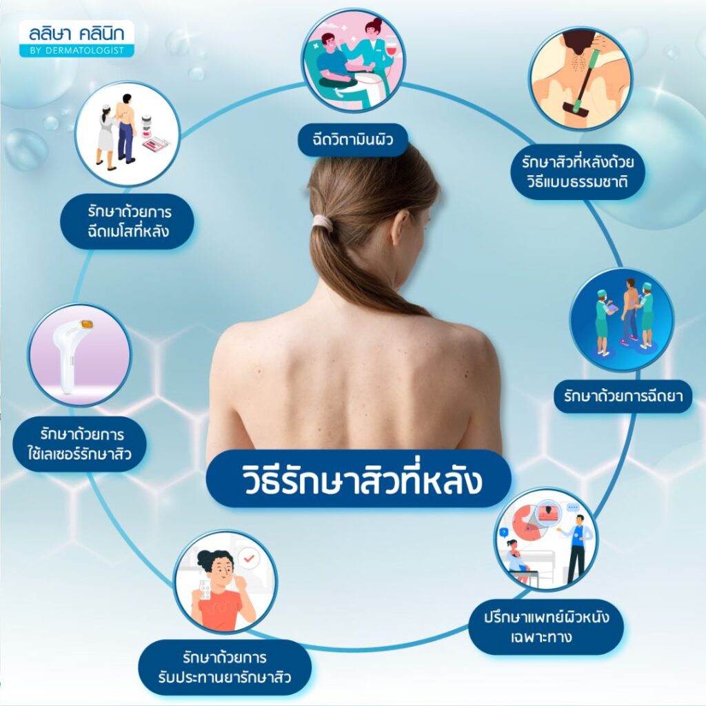 วิธีรักษาสิวที่หลัง