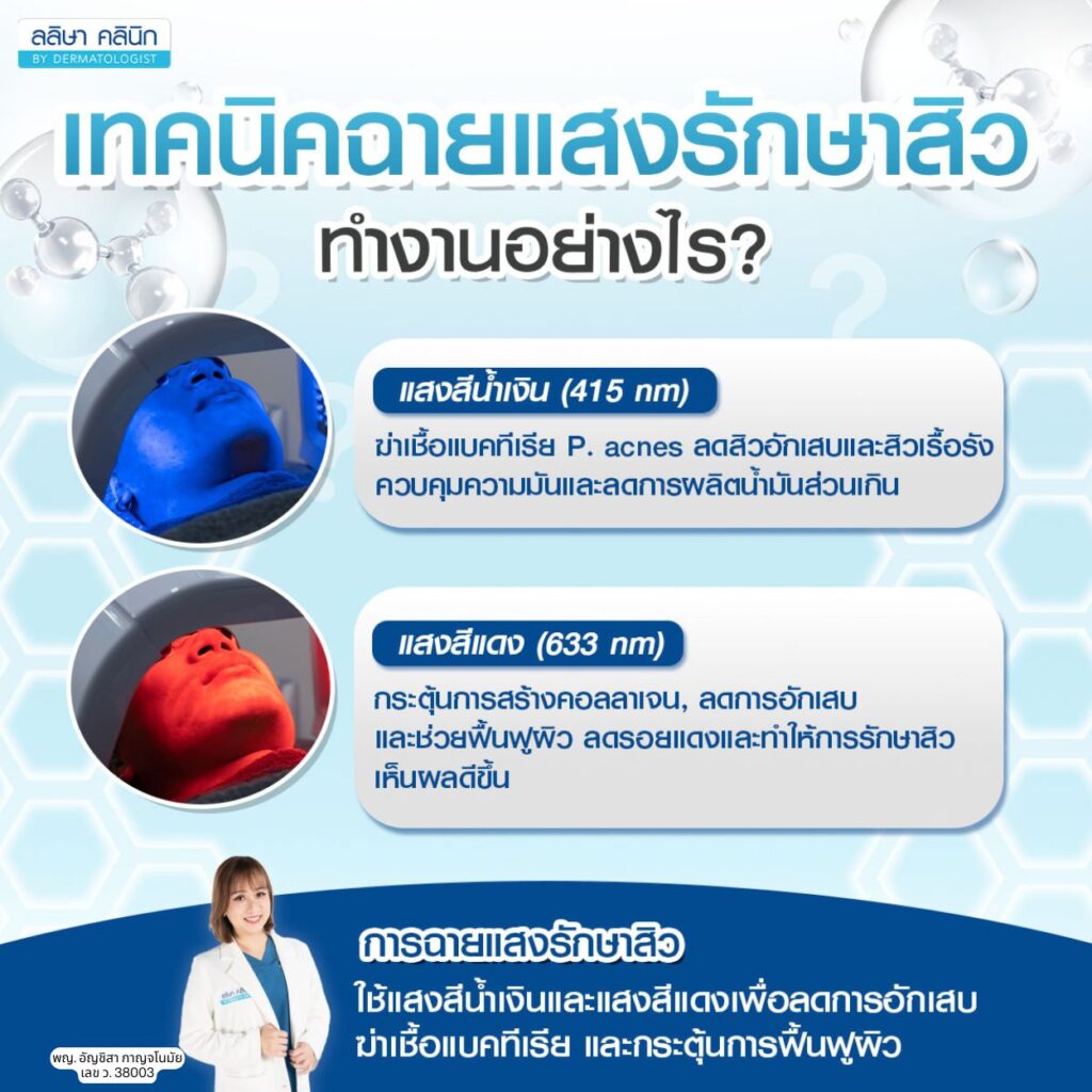 หลักการทำงานฉายแสงรักษาสิว