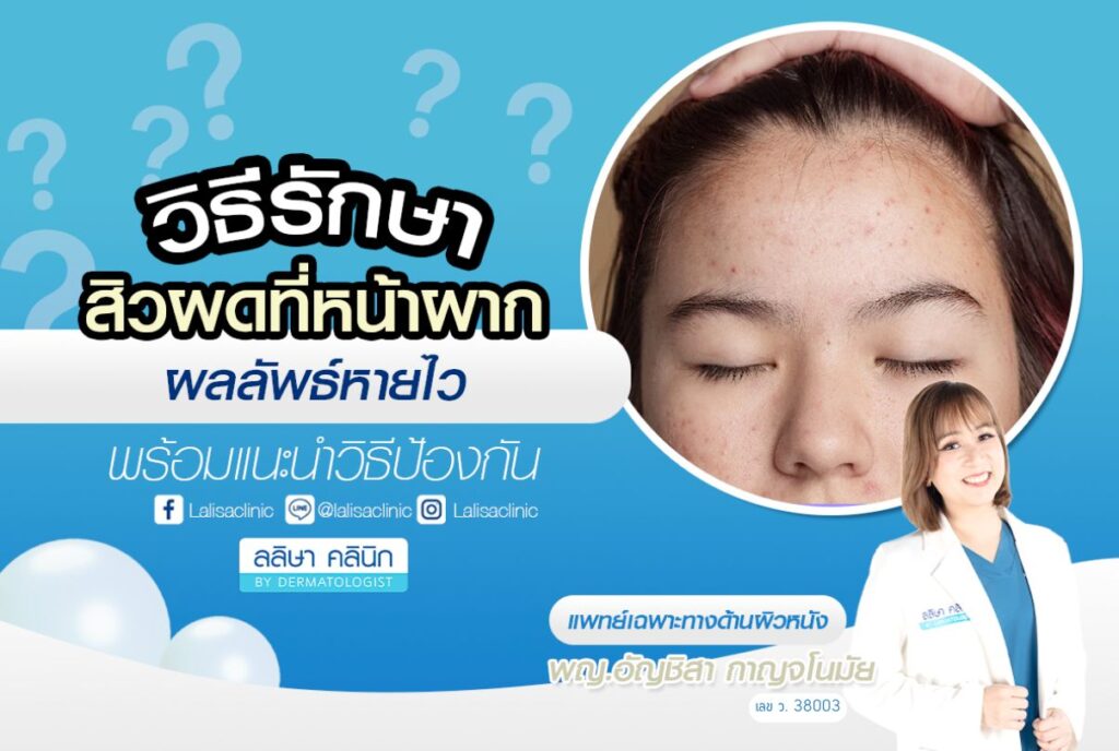 forehead-acne-rash