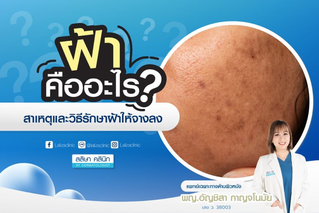melasma