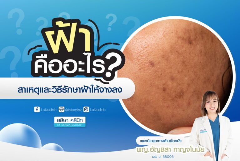 melasma