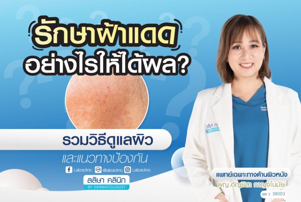melasma-sun-spot