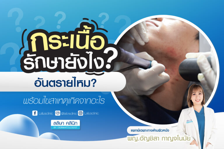 กระเนื้อ รักษายังไง อันตรายไหม สาเหตุอะไร