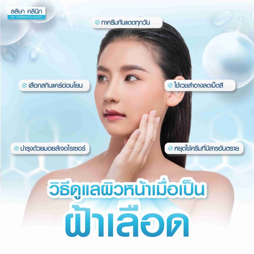 การดูแลผิวหน้าเมื่อเป็นฝ้าเลือด