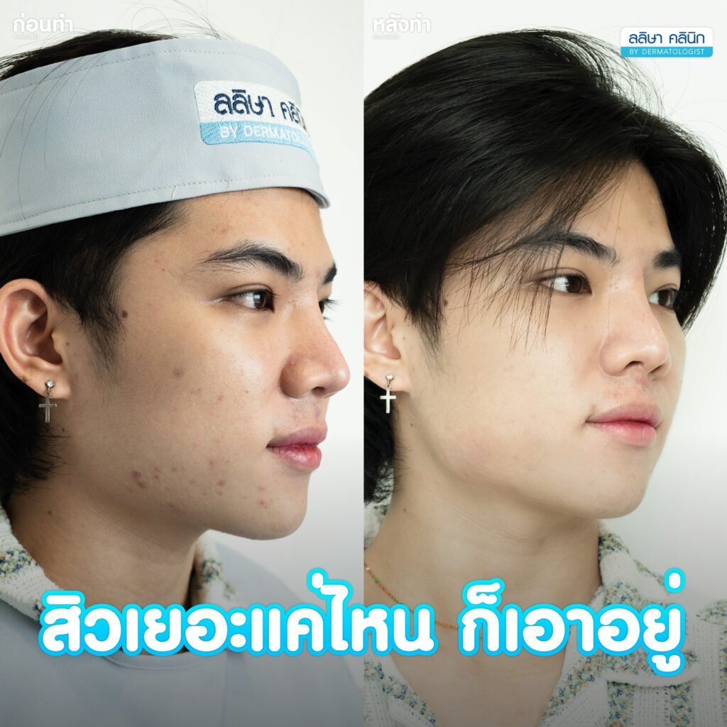 การรักษาสิวที่คลินิกรักษาสิว 02
