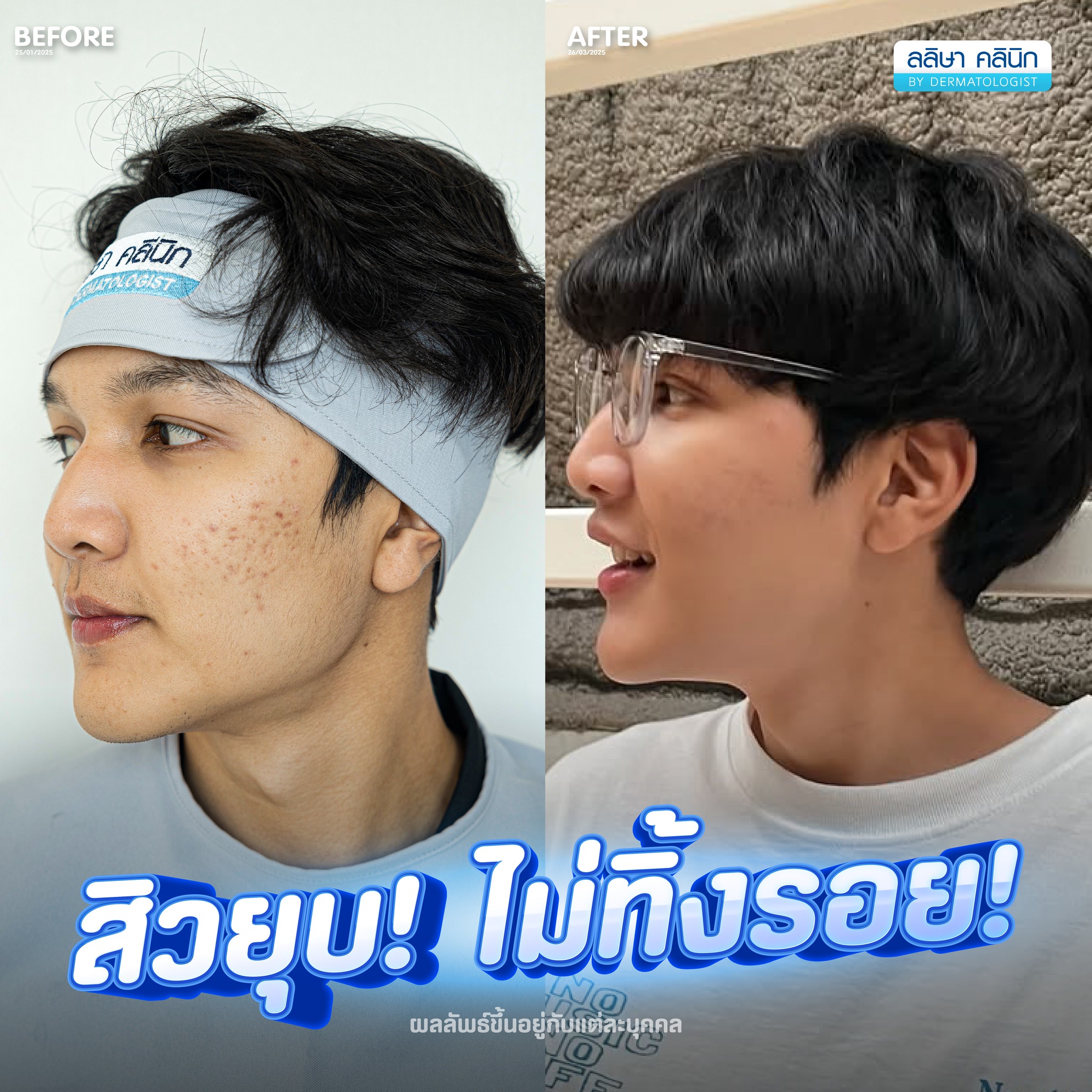การรักษาสิวที่คลินิกรักษาสิว