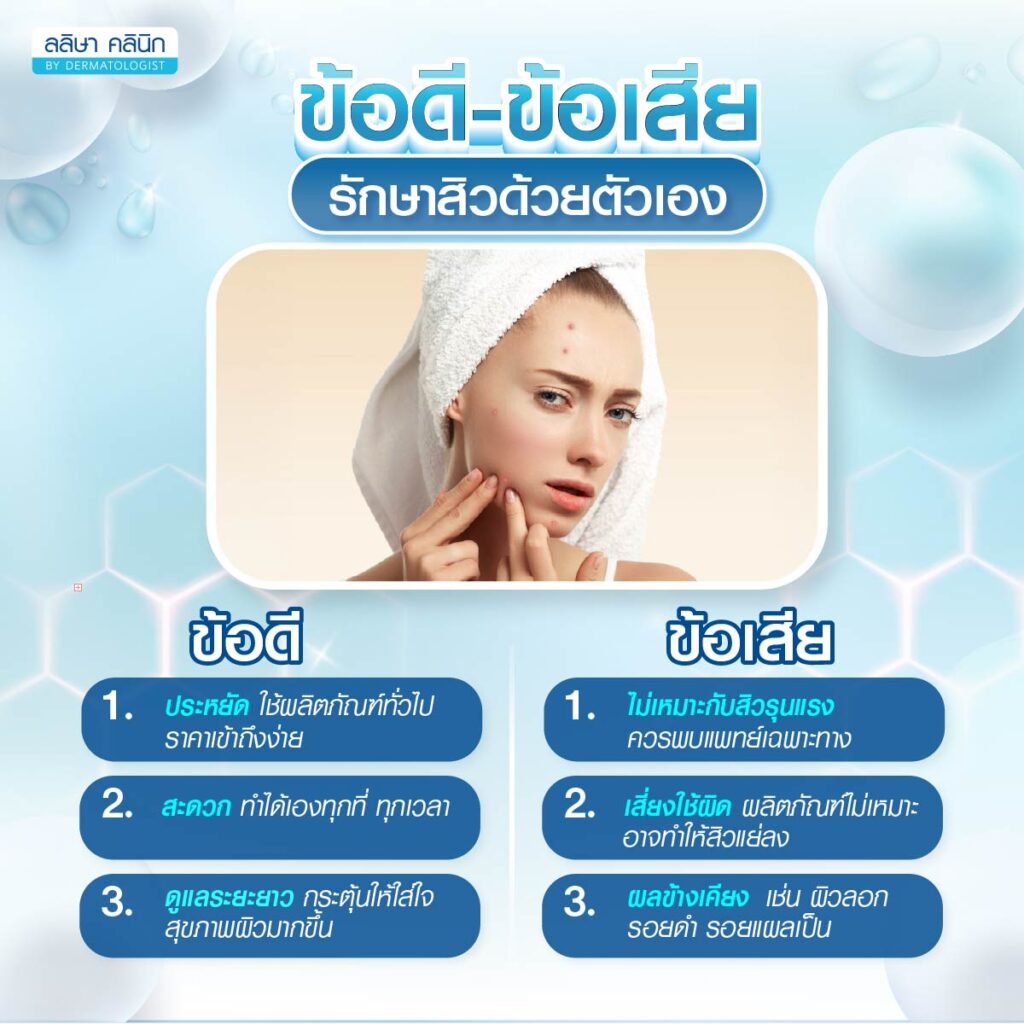 ข้อดีและข้อจำกัดรักษาสิวเอง