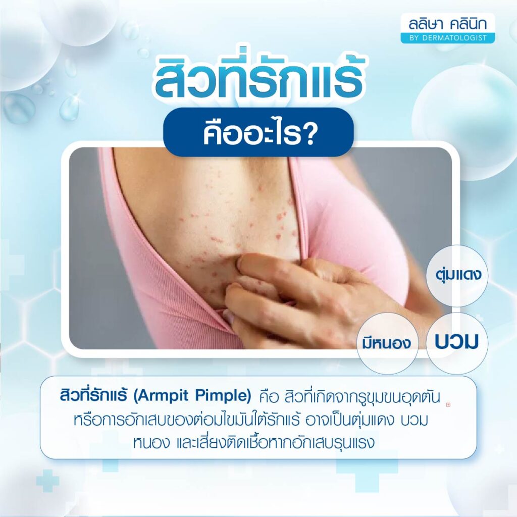 ความหมายสิวที่รักแร้