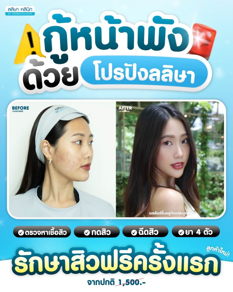 ค่าใช้จ่ายในการไปพบหมอรักษาสิว