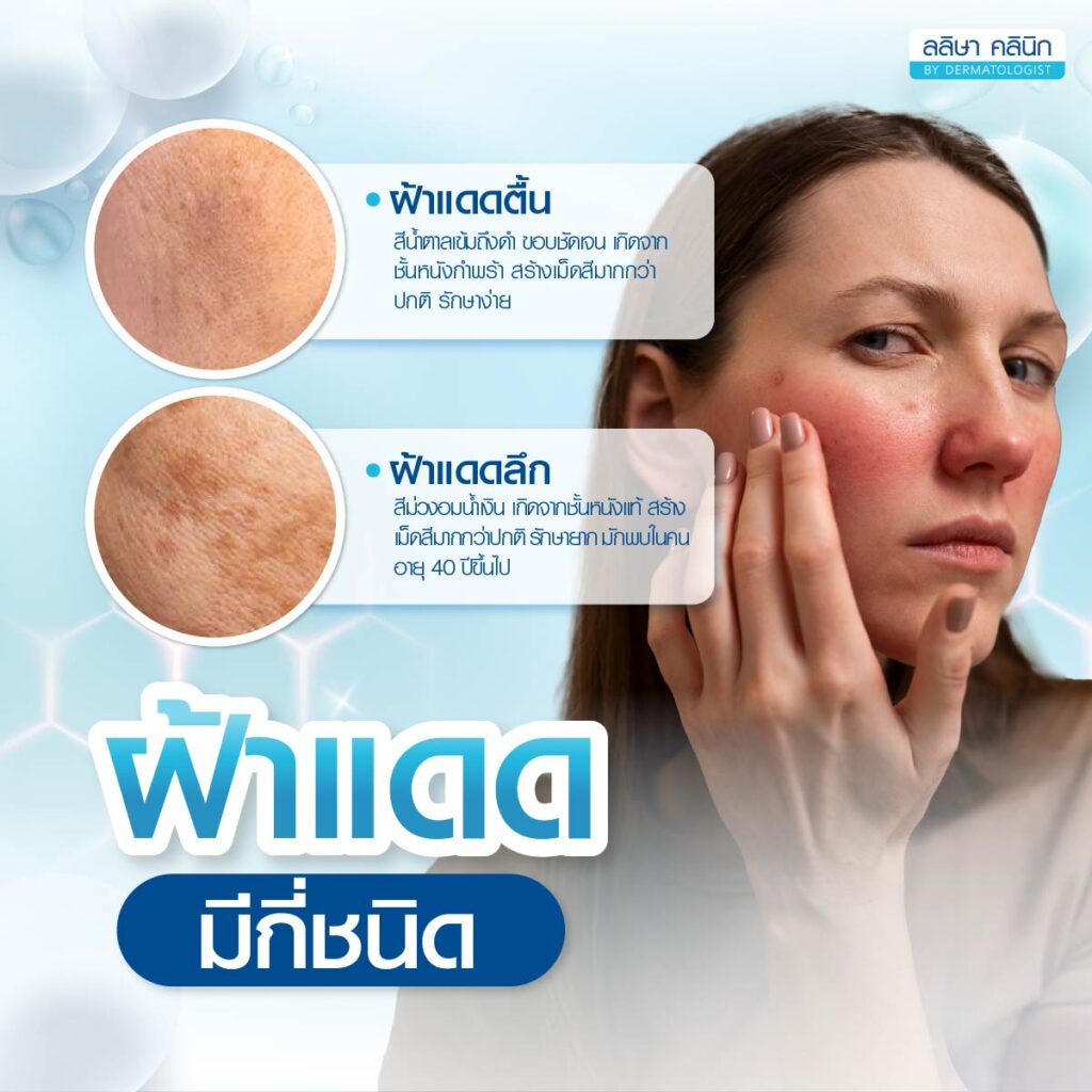 ชนิดของฝ้าแดด