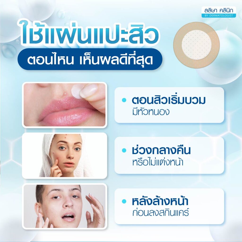 ช่วงเห็นผลของการใข้แผ่นแปะสิว