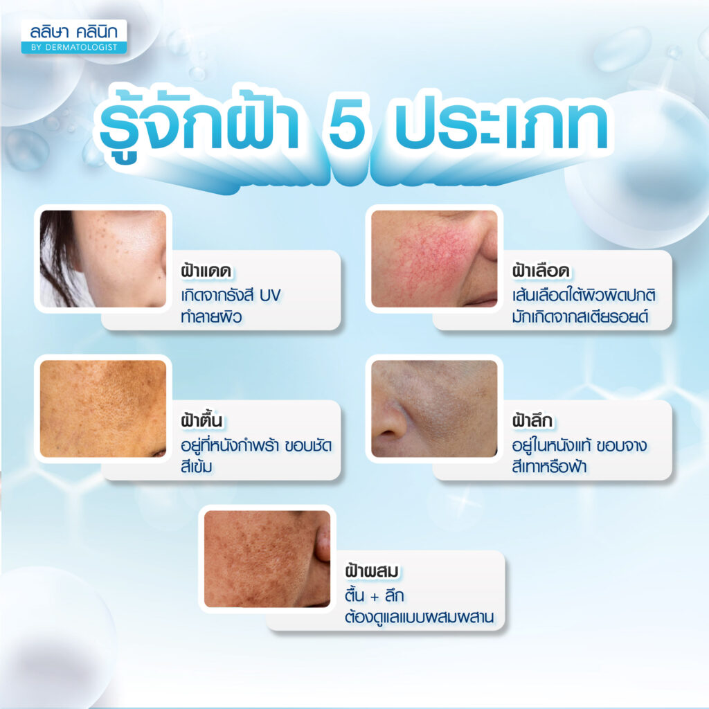 ประเภทของฝ้า