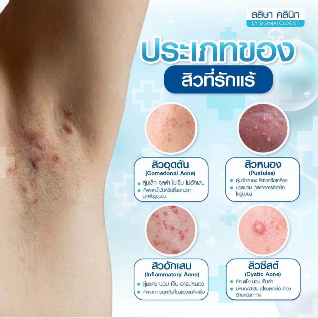 ประเภทสิวที่รักแร้