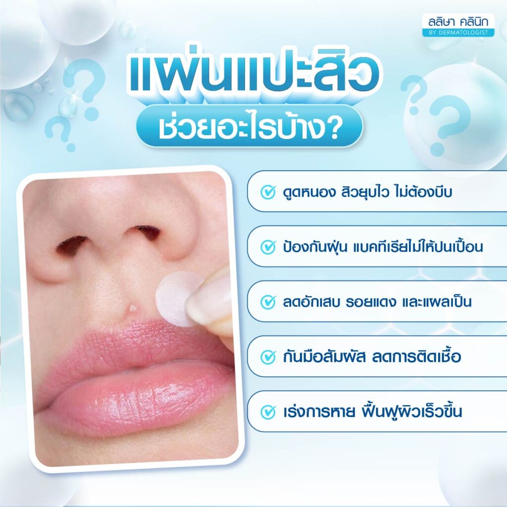 ประโยชน์แผ่นแปะสิว