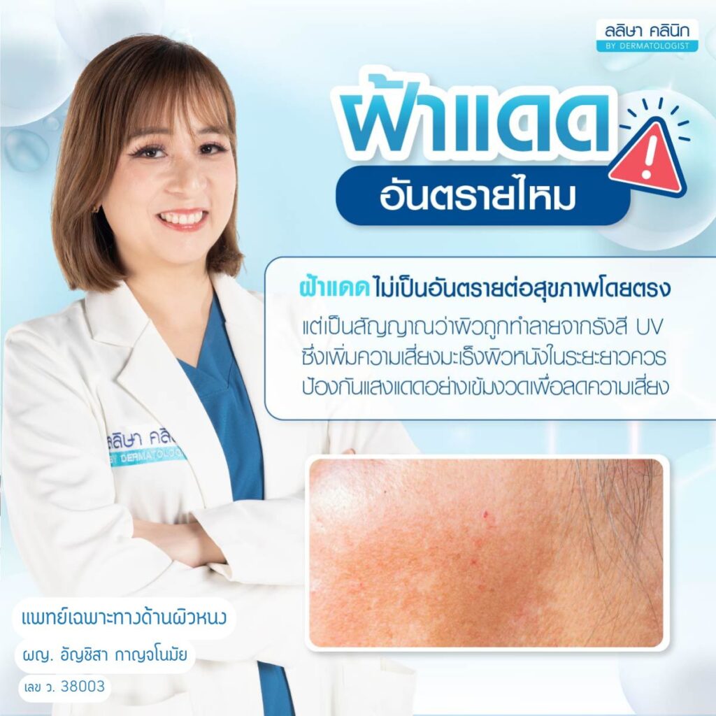 ฝ้าแดด อันตรายไหม