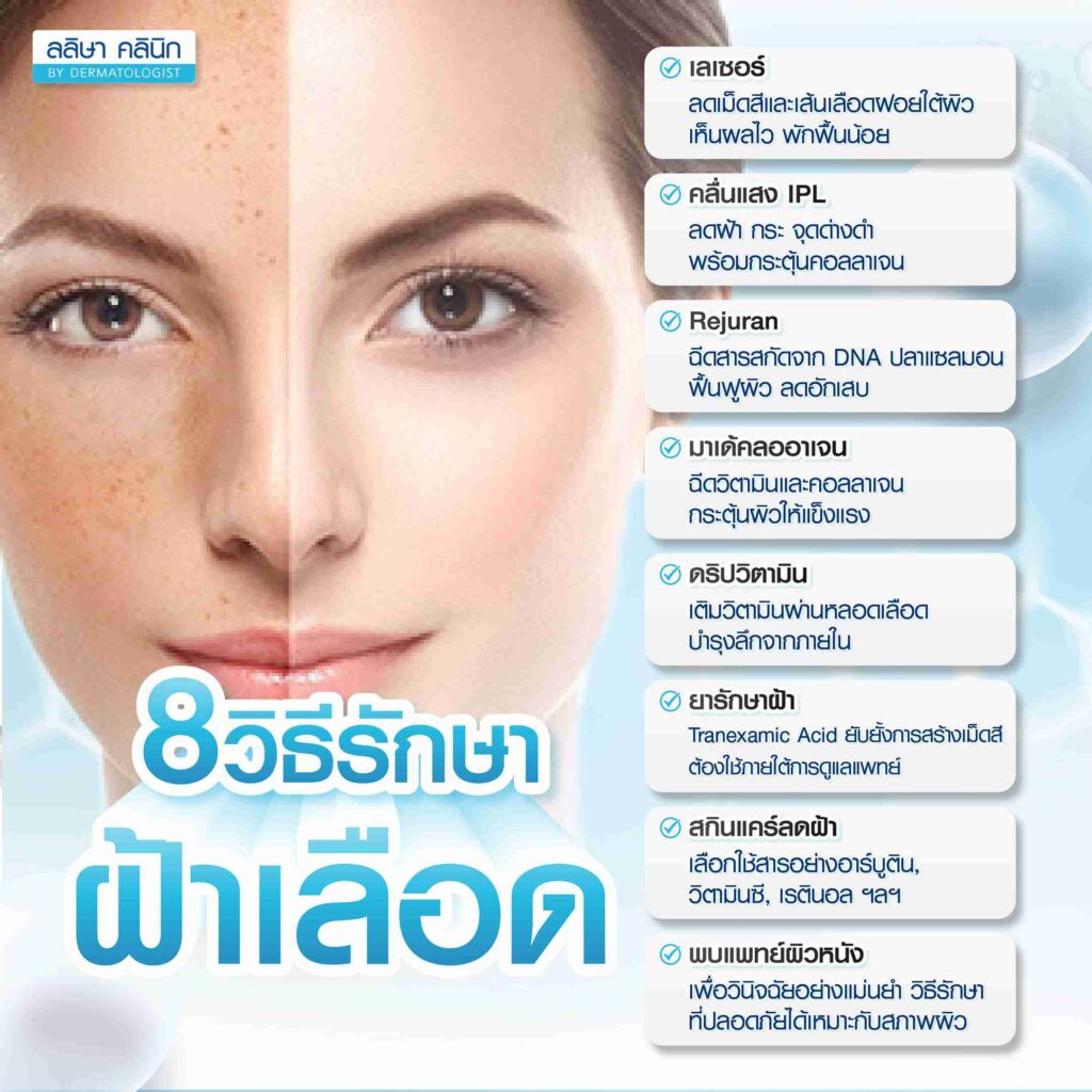 รักษาฝ้าเลือด