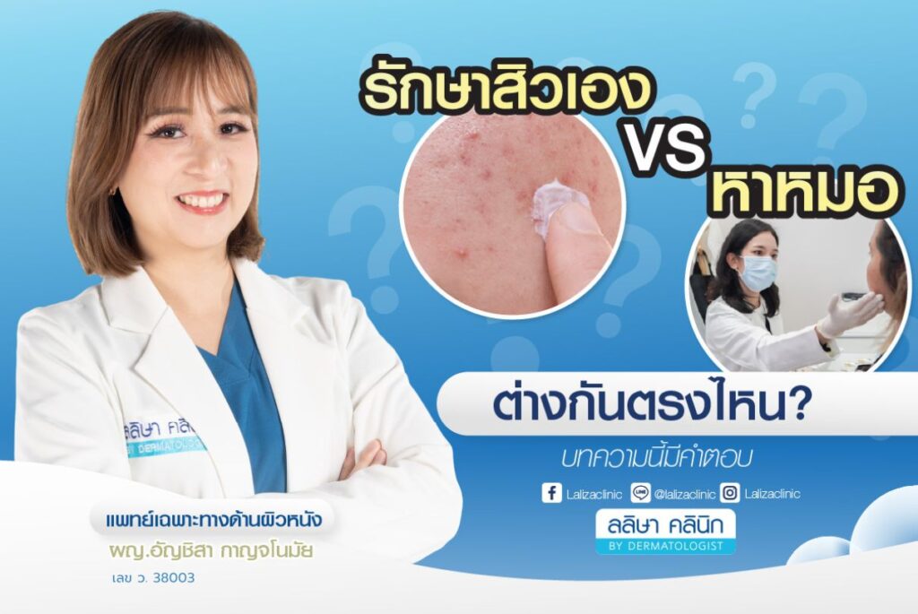 รักษาสิวเอง VS หาหมอรักษาสิว
