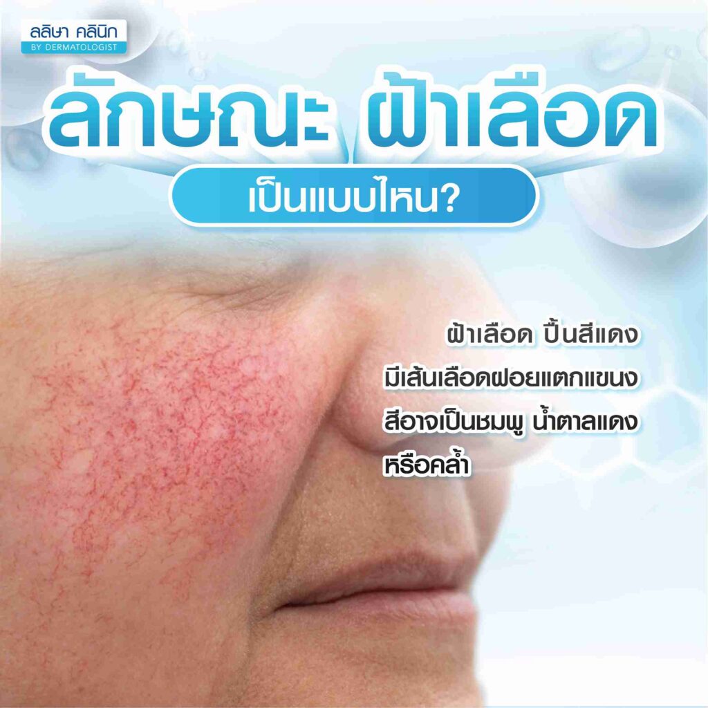 ลักษณะและอาการ ฝ้าเลือด