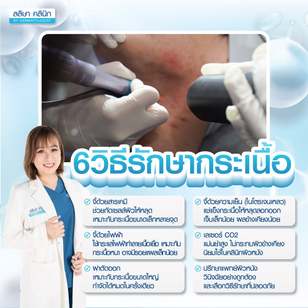 วิธีรักษากระเนื้อ