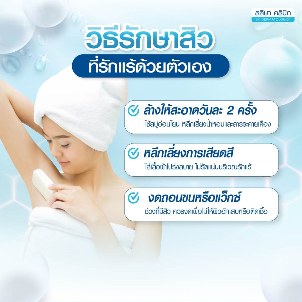 วิธีรักษาสิวที่รักแร้