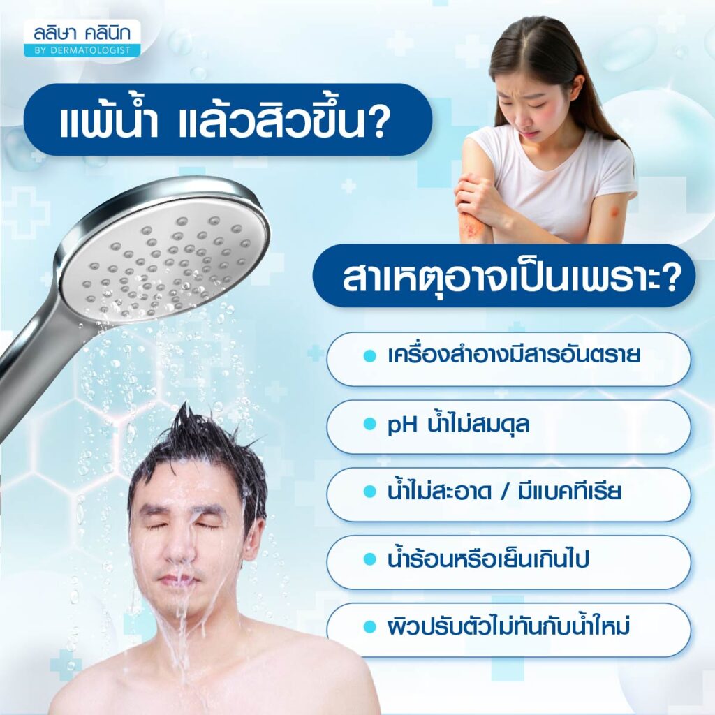 สาหตุแพ้น้ำสิวขึ้น