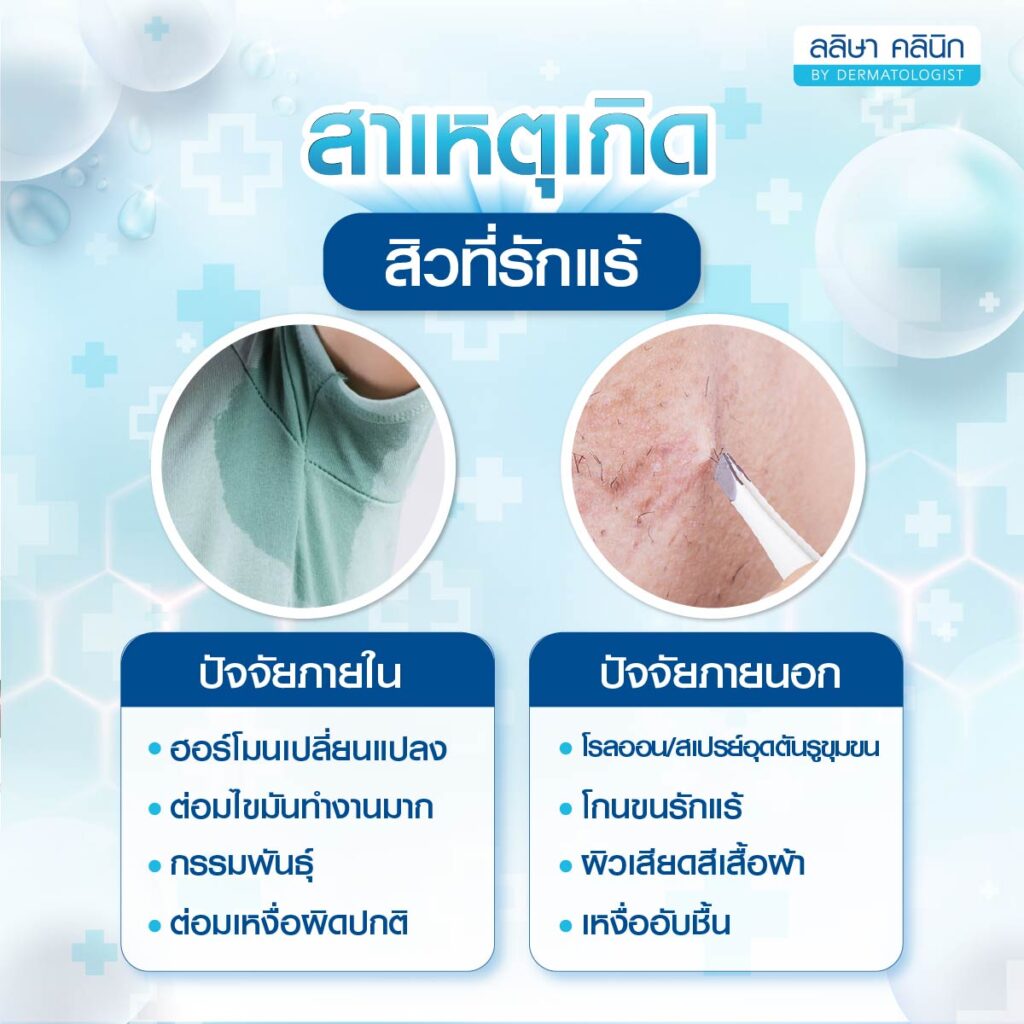 สาเหตุสิวที่รักแร้