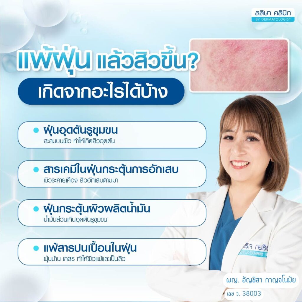 สาเหตุสิวแพ้ฝุ่น