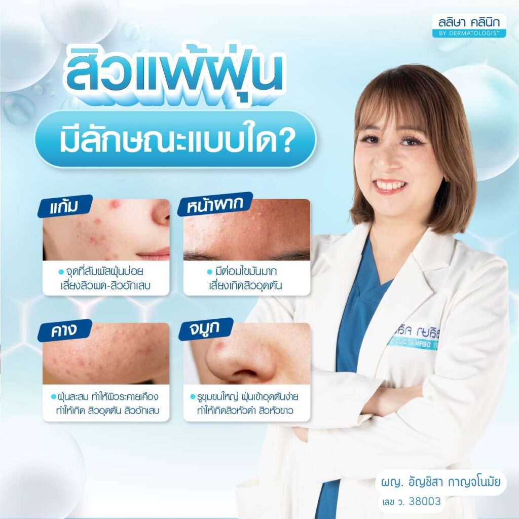 สิวแพ้ฝุ่นขึ้นจุดไหน
