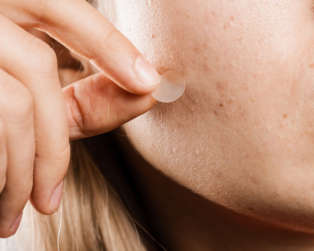 แผ่นแปะสิว