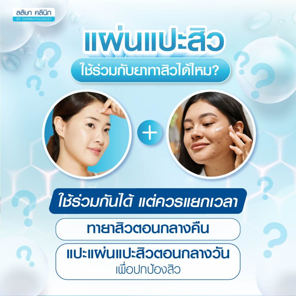 แผ่นแปะสิวใช้ร่วมกับยาทา