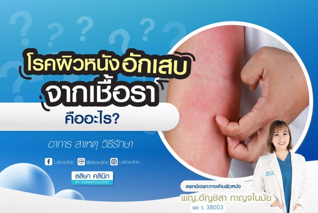 Fungal dermatitis