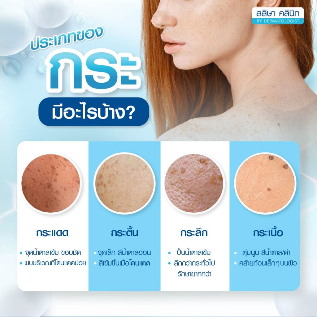 กระ ประเภทกระแดด กระตื้น กระลึก กระเนื้อ
