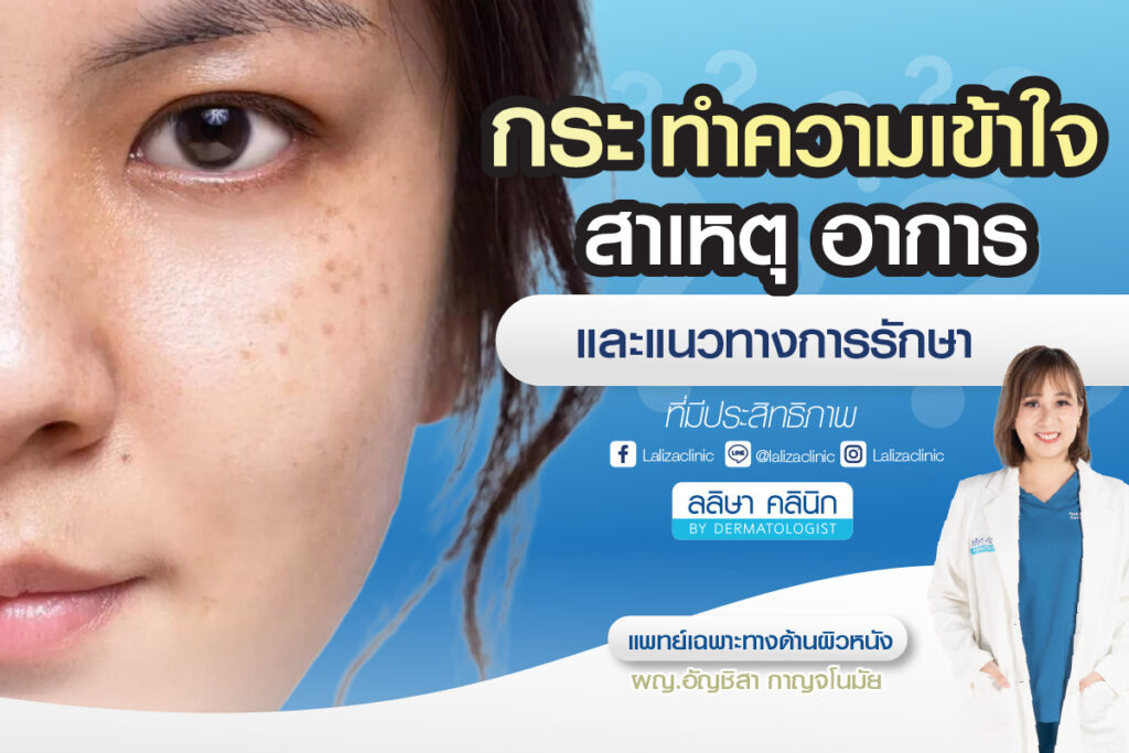 กระ สาเหตุ อาการ วิธีรักษา