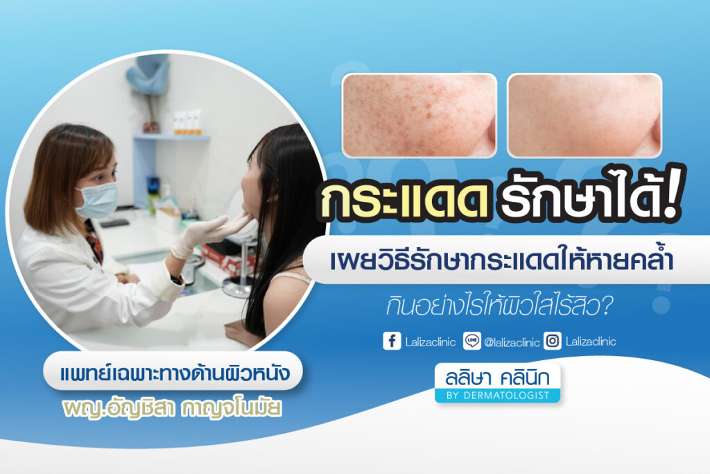 กระแดดSolar Lentigo คืออะไร รักษายังไง