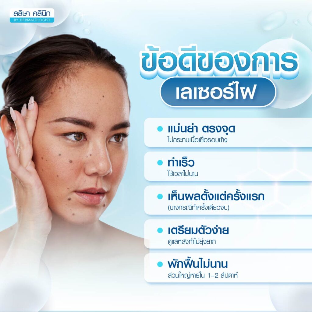 ข้อดีการเลเซอร์ไฝ