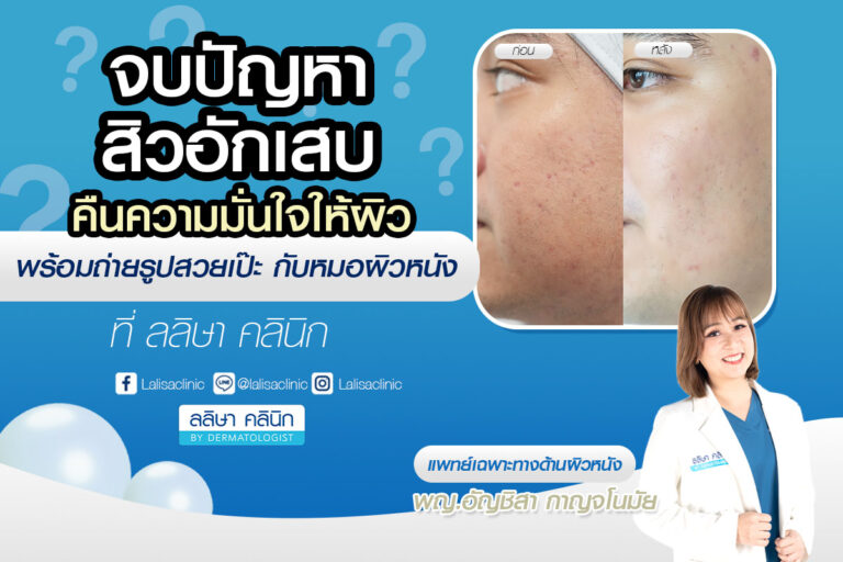 คุณซานรักษาสิวทั่วหน้า