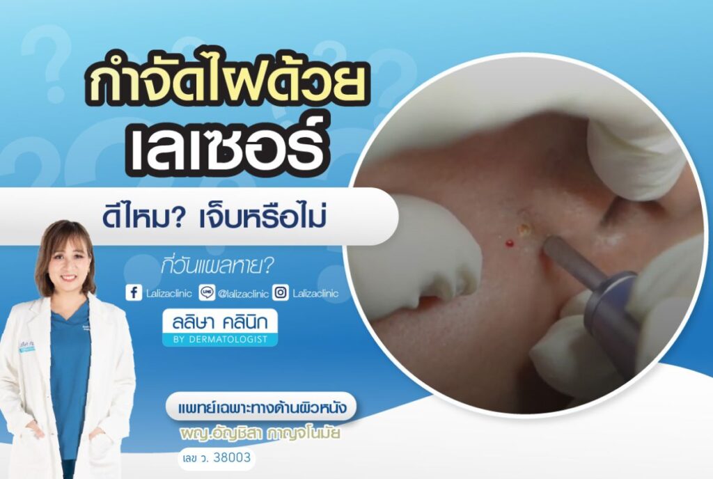 จี้ไฝด้วยเลเซอร์ ดีไหม เจ็บไหม