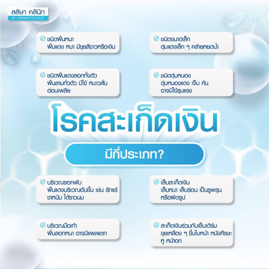 ชนิดโรคสะเก็ดเงิน
