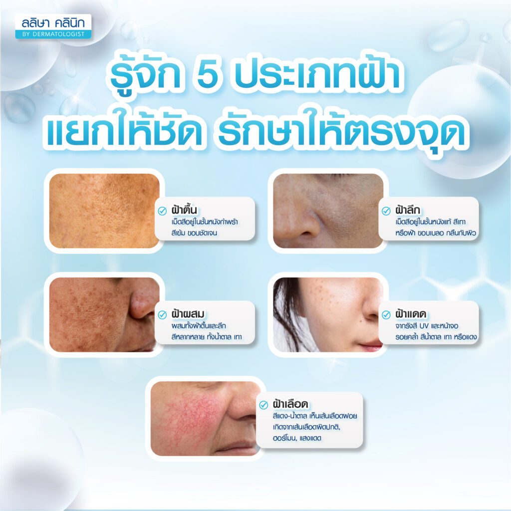 ประเภทของฝ้า