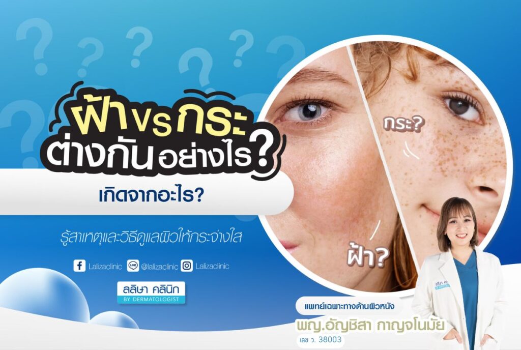 ฝ้า VS กระ ต่างกันอย่างไร มักจะเกิดตำแหน่งไหน รู้สาเหตุและวิธีสังเกต