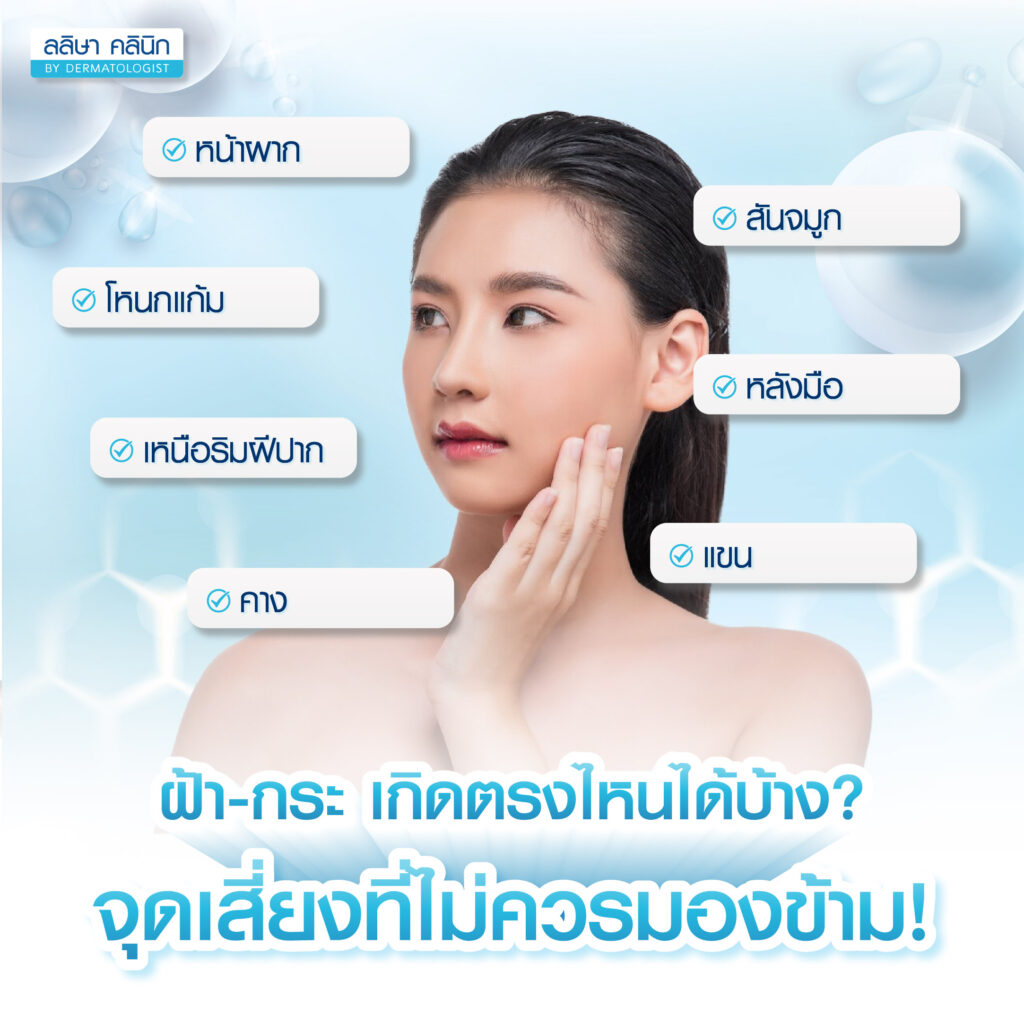 ฝ้า กระ เกิดตำแหน่งไหนได้บ้าง