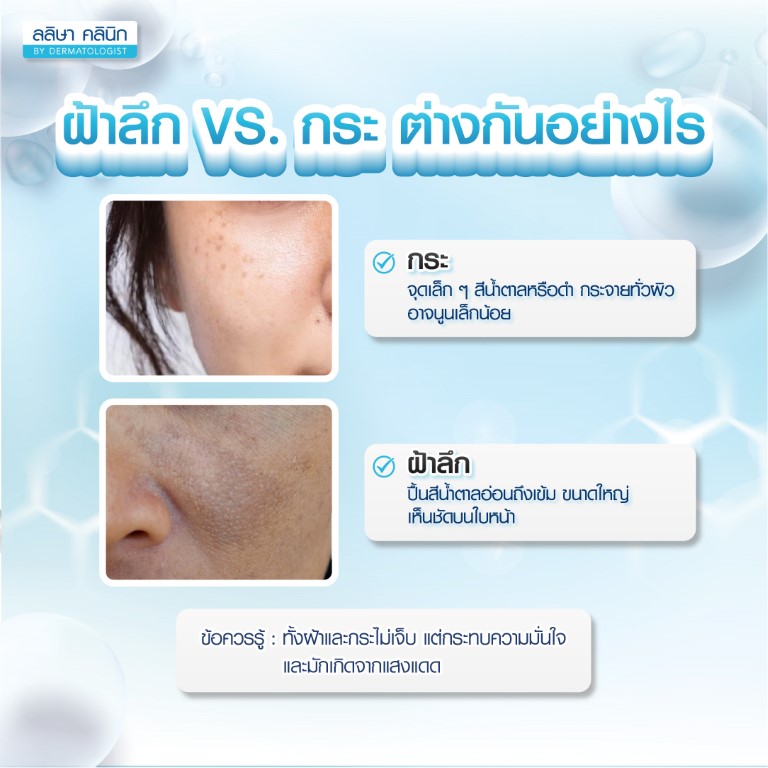 ฝ้าลึก VS กระ ต่างกันอย่างไร