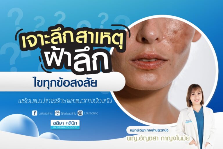 ฝ้าลึก การรักษาและแนวทางป้องกัน