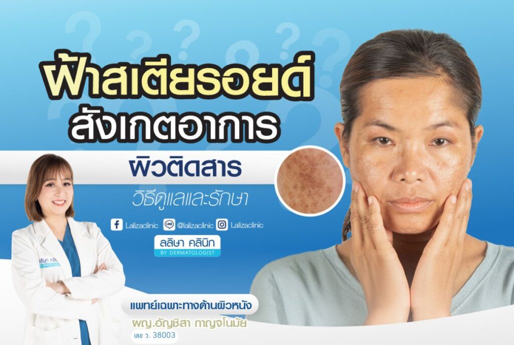 ฝ้าสเตียรอยด์ สาเหตุ และการรักษา