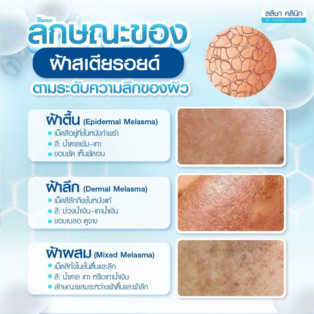 ฝ้าสเตียรอยด์ตามระดับความลึกของผิว