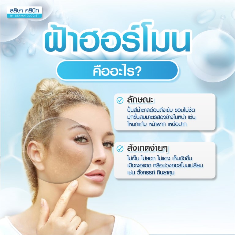 ฝ้าฮอร์โมน คือ
