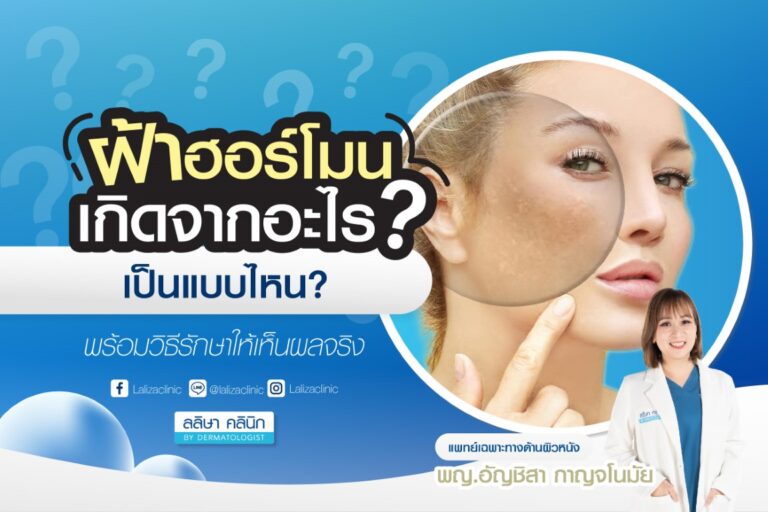 ฝ้าฮอร์โมนเกิดจากอะไร เป็นแบบไหน วิธีรักษา