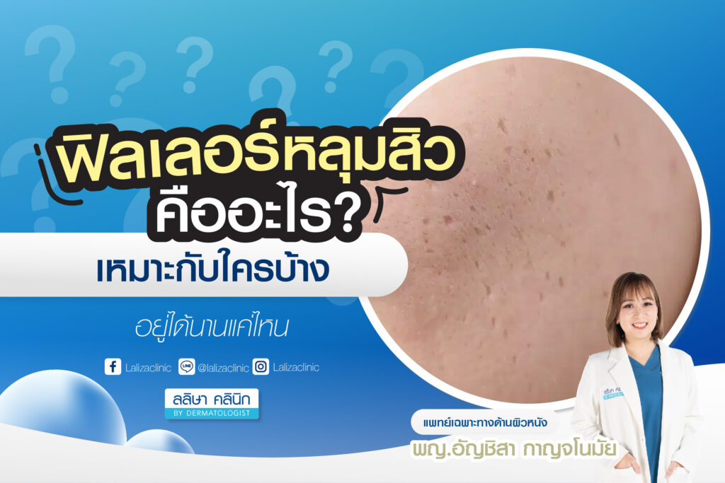 ฟิลเลอร์หลุมสิวคือ เหมาะกับใคร ฉีดแล้วอยู่ได้นานแค่ไหน